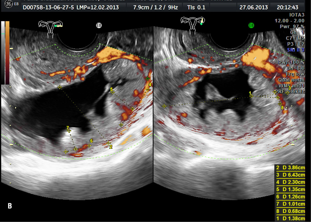 Expert endometriosis ultrasound examination in Gdańsk